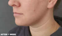 Coolsculpting
