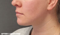 Coolsculpting