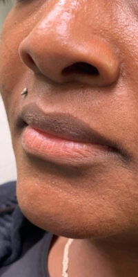 Dermal Fillers