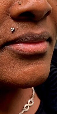 Dermal Fillers