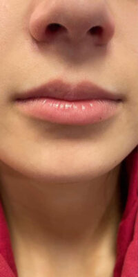 Dermal Fillers