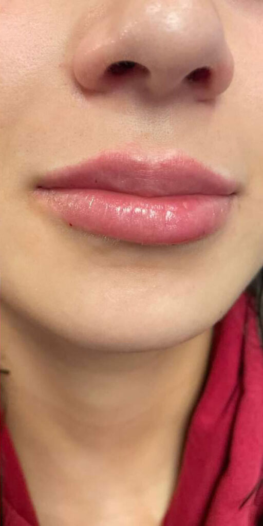 Dermal Fillers