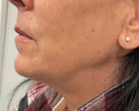 Vein Removal