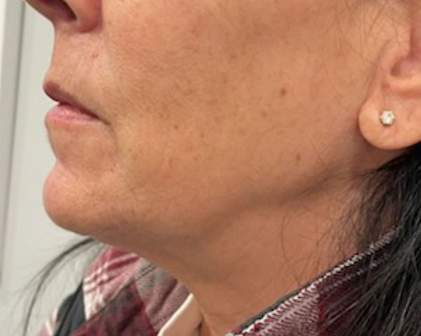 Vein Removal