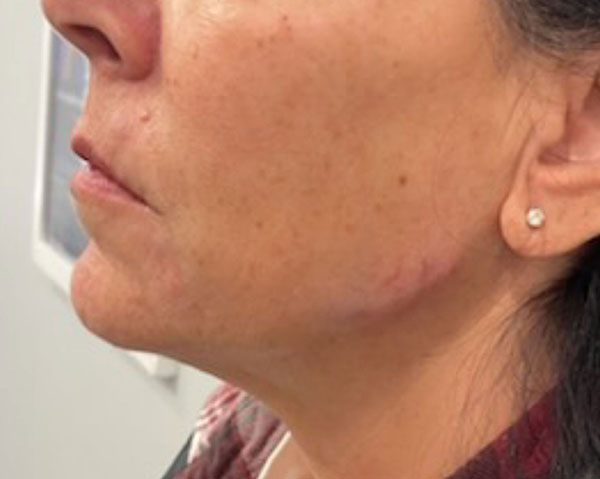 Vein Removal