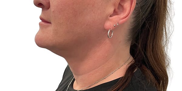 Kybella