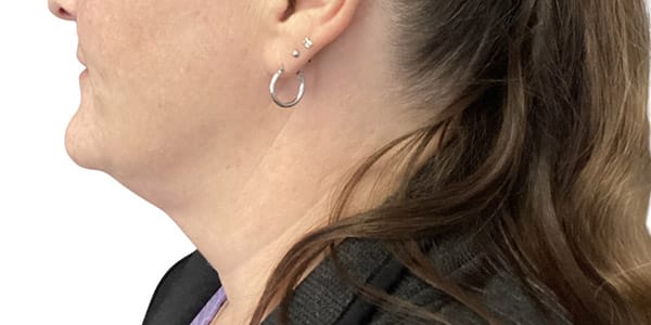 Kybella