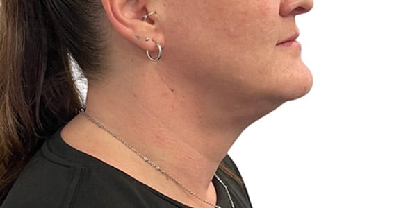 Kybella