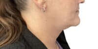 Kybella